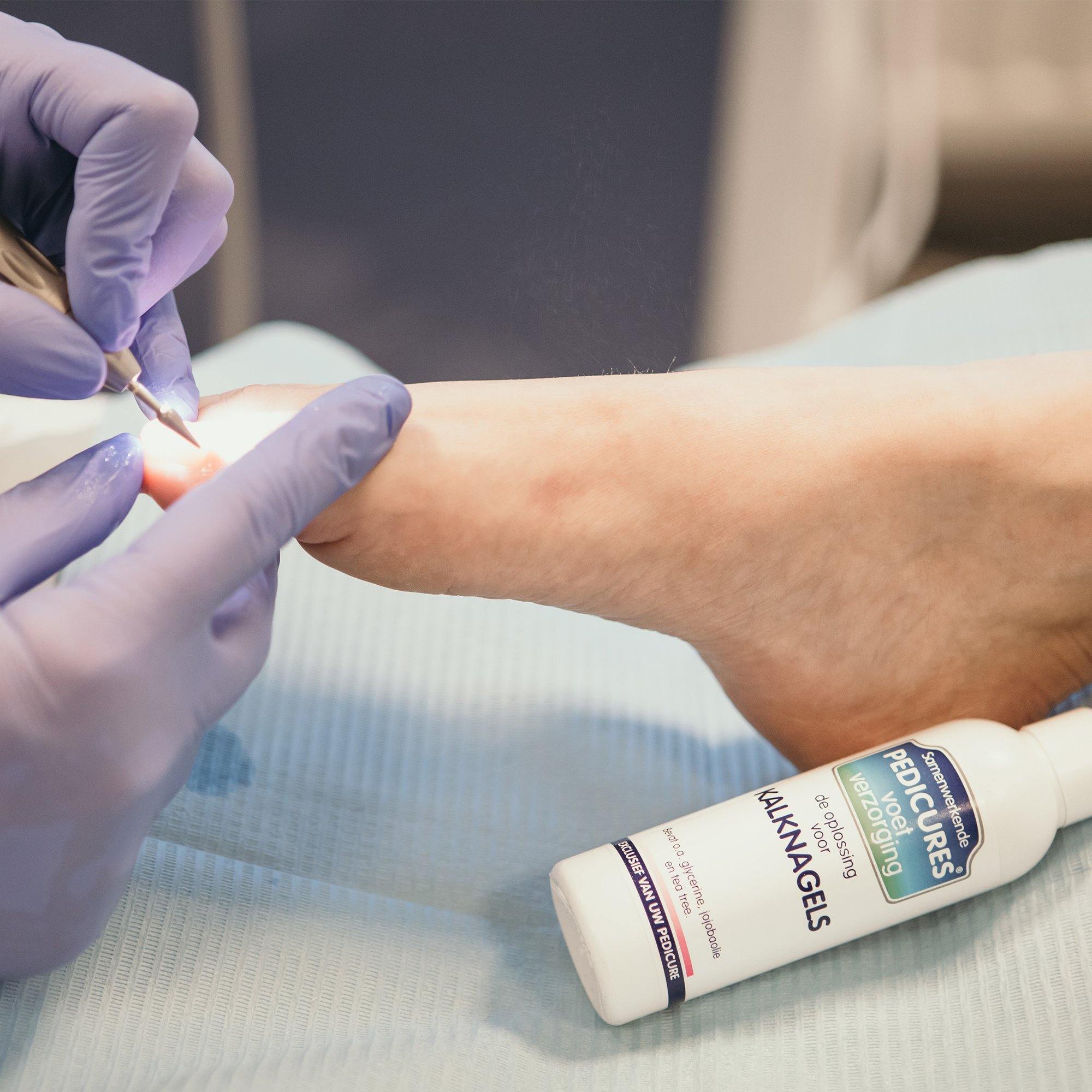 Samenwerkende Pedicures kalknagel olie tea tree